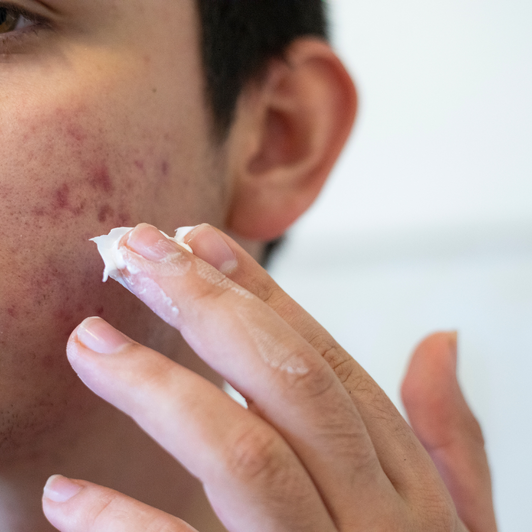 Can shaving cause acne?