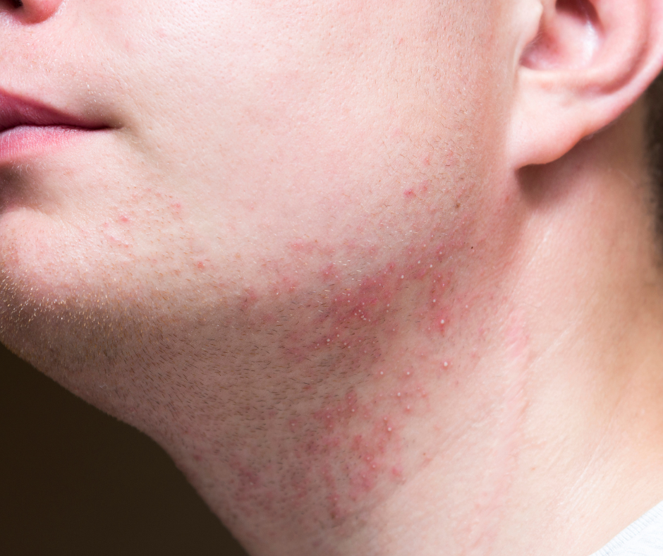 Why Your Shaving Cream Might Be Causing Razor Burn (And What to Use Instead)